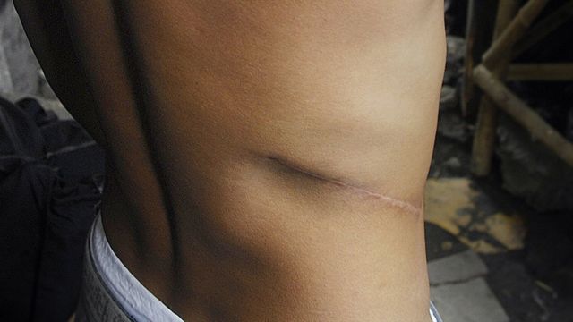 Scar for di body of one man wey sell im kidney